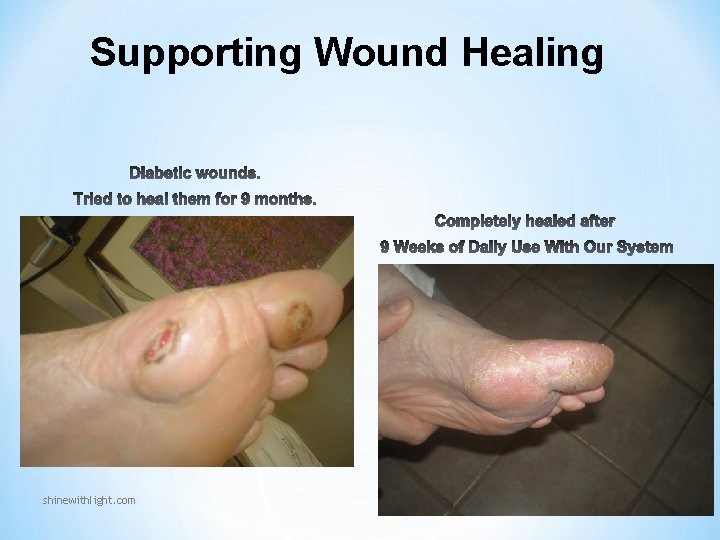 Supporting Wound Healing shinewithlight. com Supporting Wound Healing shinewithlight. com