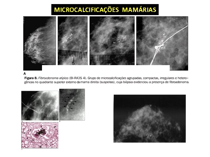 MICROCALCIFICAÇÕES MAMÁRIAS 