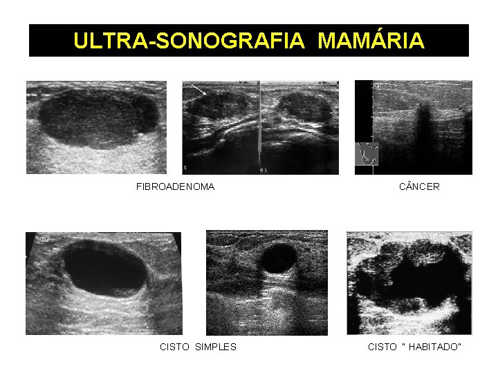 ULTRA-SONOGRAFIA MAMÁRIA FIBROADENOMA CISTO SIMPLES C NCER CISTO “ HABITADO” 