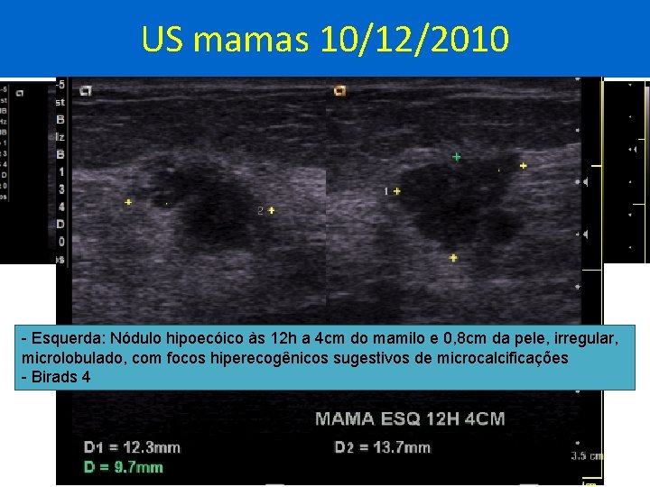 US mamas 10/12/2010 - Esquerda: Nódulo hipoecóico às 12 h a 4 cm do