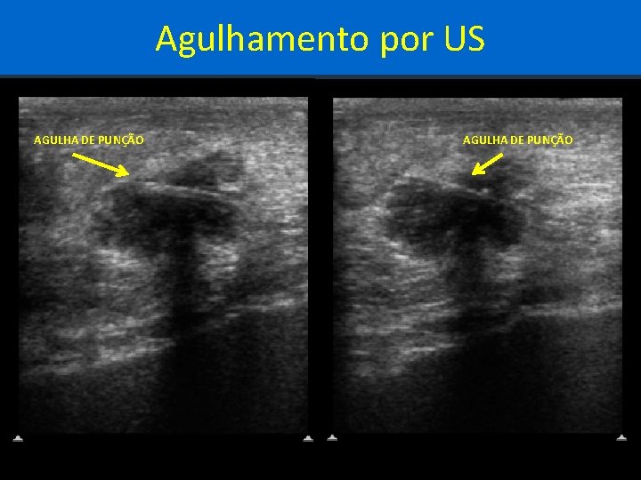 Agulhamento por US AGULHA DE PUNÇÃO 