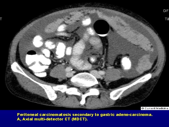 Peritoneal carcinomatosis secondary to gastric adeno-carcinoma. A, Axial multi-detector CT (MDCT). 