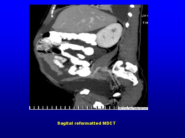 Sagital reformatted MDCT 