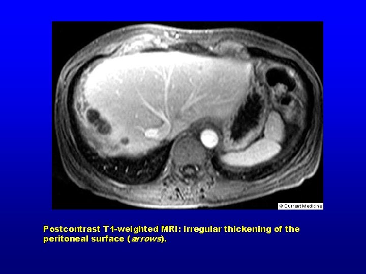 Postcontrast T 1 -weighted MRI: irregular thickening of the peritoneal surface (arrows). 