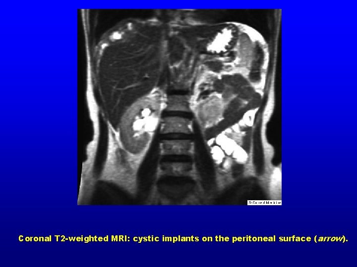 Coronal T 2 -weighted MRI: cystic implants on the peritoneal surface ( arrow). 