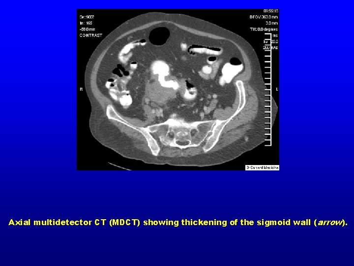 Axial multidetector CT (MDCT) showing thickening of the sigmoid wall ( arrow). 