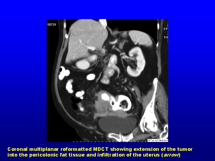 Coronal multiplanar reformatted MDCT showing extension of the tumor into the pericolonic fat tissue