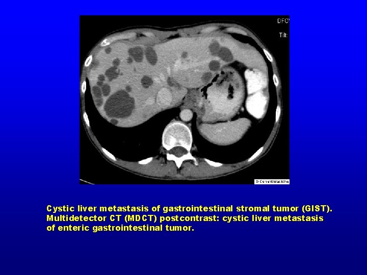 Cystic liver metastasis of gastrointestinal stromal tumor (GIST). Multidetector CT (MDCT) postcontrast: cystic liver