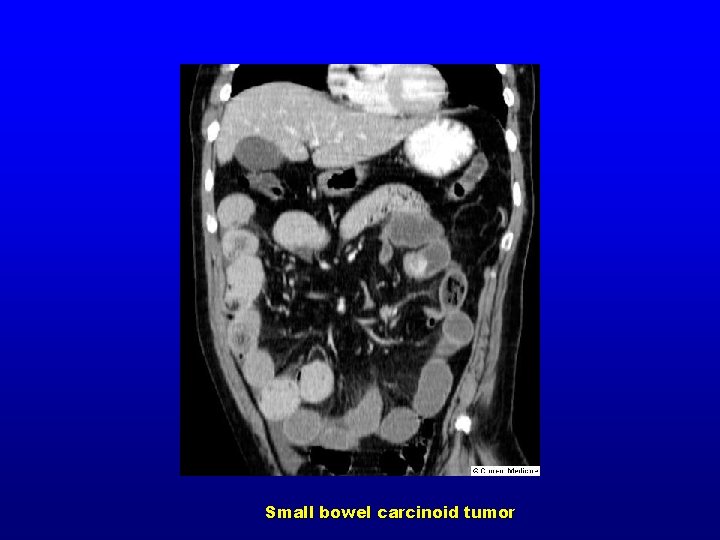 Small bowel carcinoid tumor 