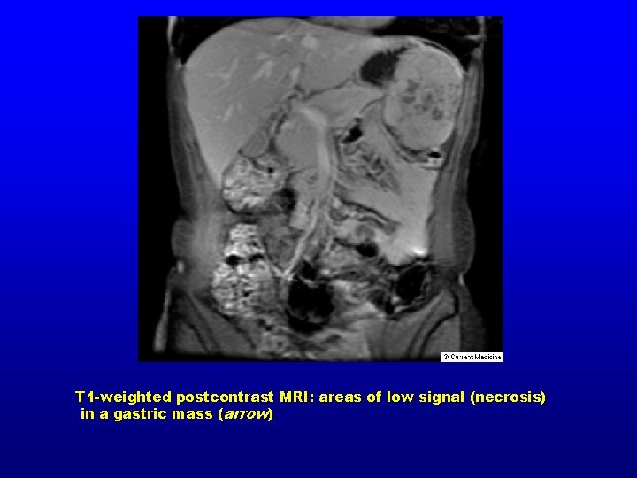 T 1 -weighted postcontrast MRI: areas of low signal (necrosis) in a gastric mass