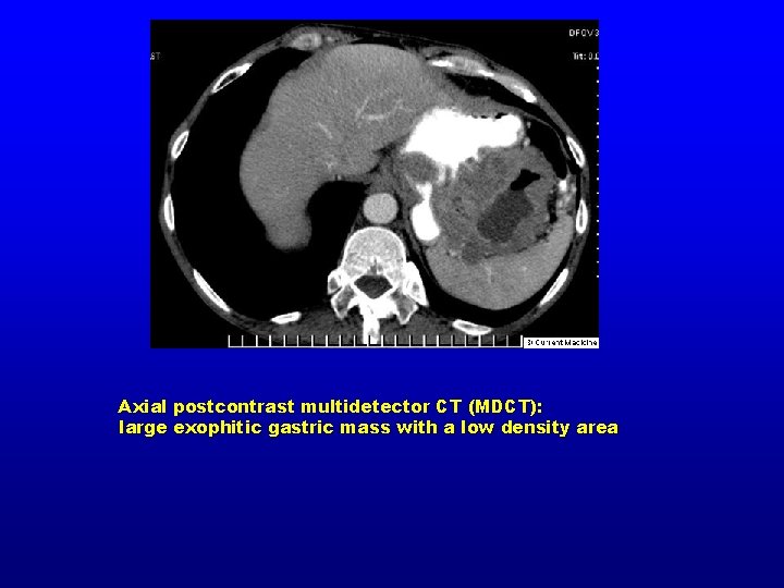 Axial postcontrast multidetector CT (MDCT): large exophitic gastric mass with a low density area