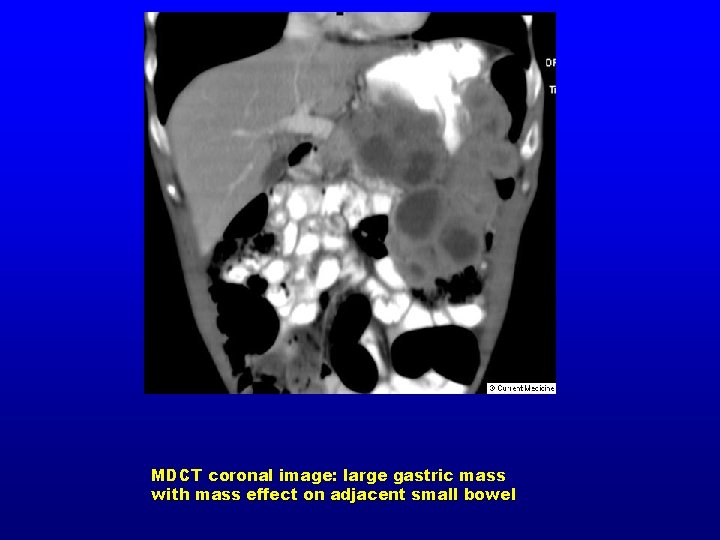 MDCT coronal image: large gastric mass with mass effect on adjacent small bowel 