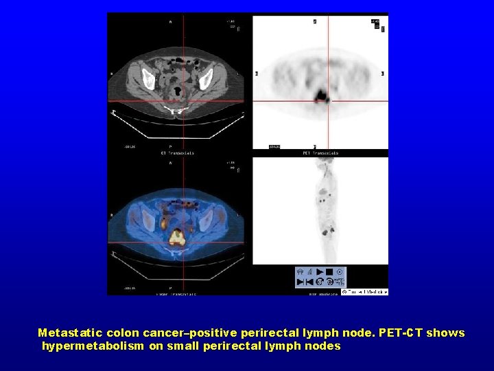 Metastatic colon cancer–positive perirectal lymph node. PET-CT shows hypermetabolism on small perirectal lymph nodes