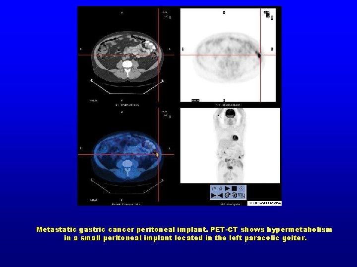 Metastatic gastric cancer peritoneal implant. PET-CT shows hypermetabolism in a small peritoneal implant located