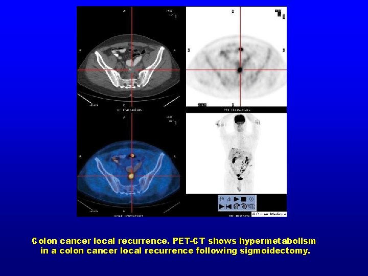 Colon cancer local recurrence. PET-CT shows hypermetabolism in a colon cancer local recurrence following