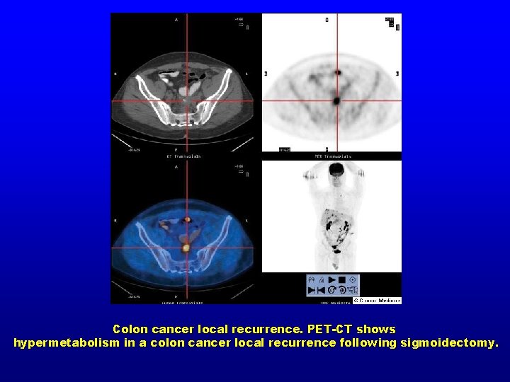 Colon cancer local recurrence. PET-CT shows hypermetabolism in a colon cancer local recurrence following
