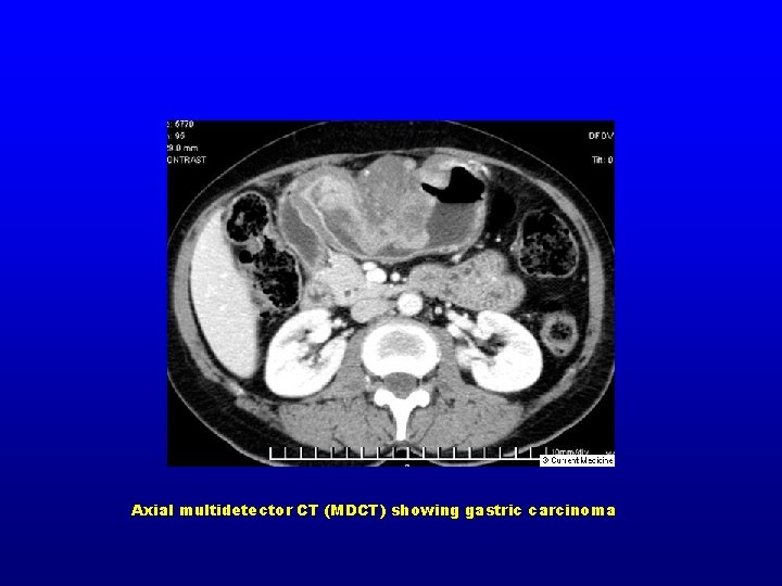 Axial multidetector CT (MDCT) showing gastric carcinoma 