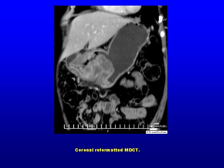 Coronal reformatted MDCT. 