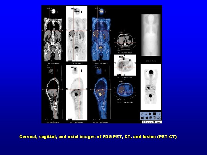 Coronal, sagittal, and axial images of FDG-PET, CT, and fusion (PET-CT) 