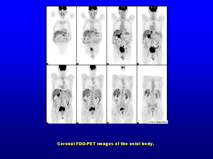 Coronal FDG-PET images of the axial body. 