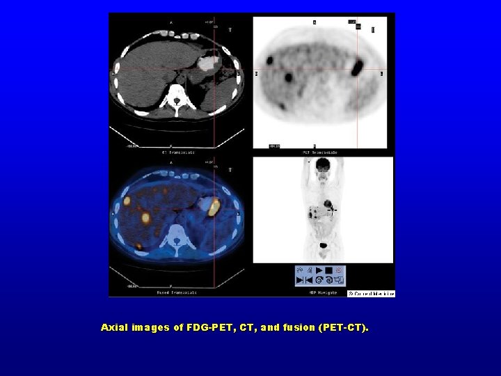 Axial images of FDG-PET, CT, and fusion (PET-CT). 