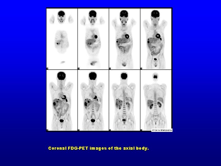 Coronal FDG-PET images of the axial body. 