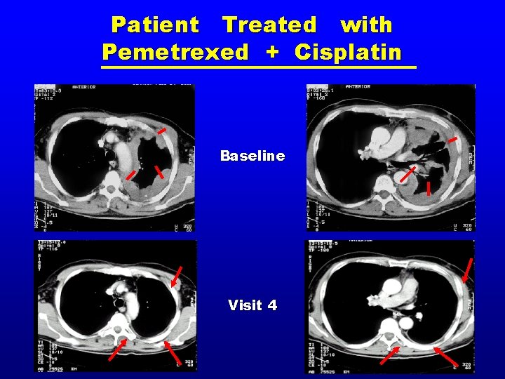 Patient Treated with Pemetrexed + Cisplatin Baseline Visit 4 