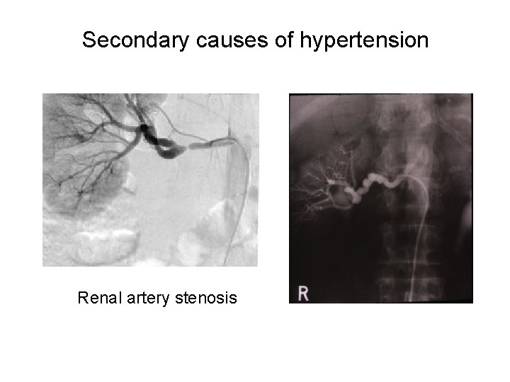 Secondary causes of hypertension Renal artery stenosis 