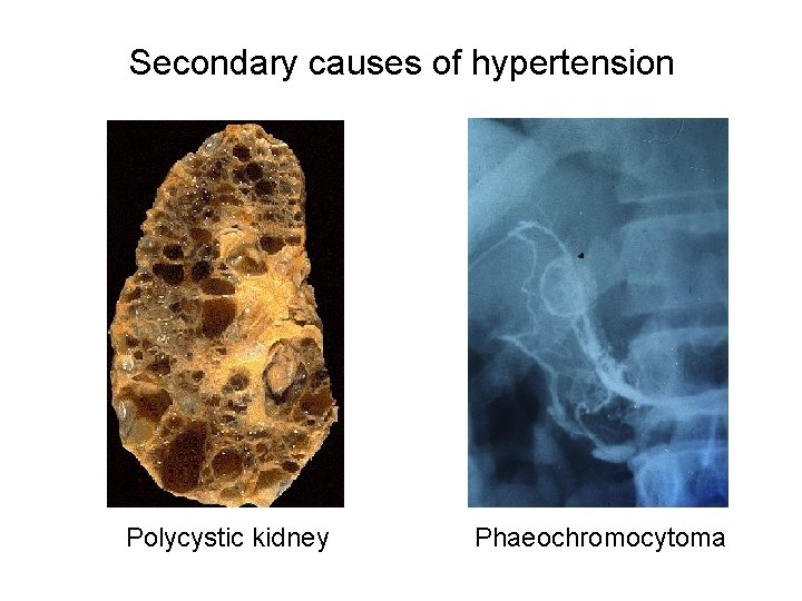 Secondary causes of hypertension Polycystic kidney Phaeochromocytoma 