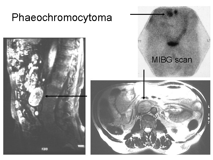 Phaeochromocytoma MIBG scan 