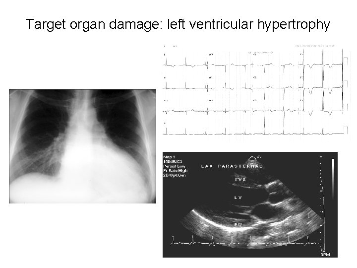 Target organ damage: left ventricular hypertrophy 