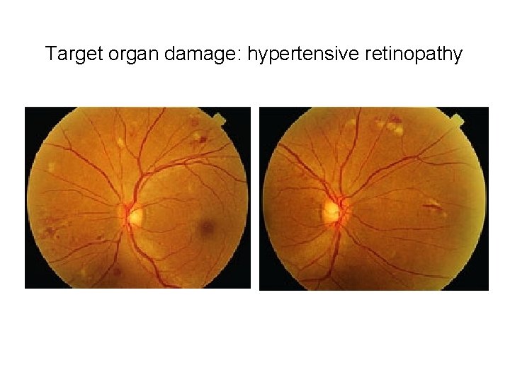 Target organ damage: hypertensive retinopathy 