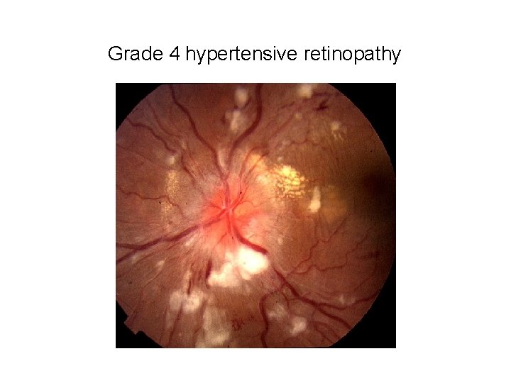 Grade 4 hypertensive retinopathy 
