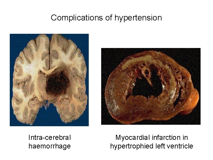 Complications of hypertension Intra-cerebral haemorrhage Myocardial infarction in hypertrophied left ventricle 