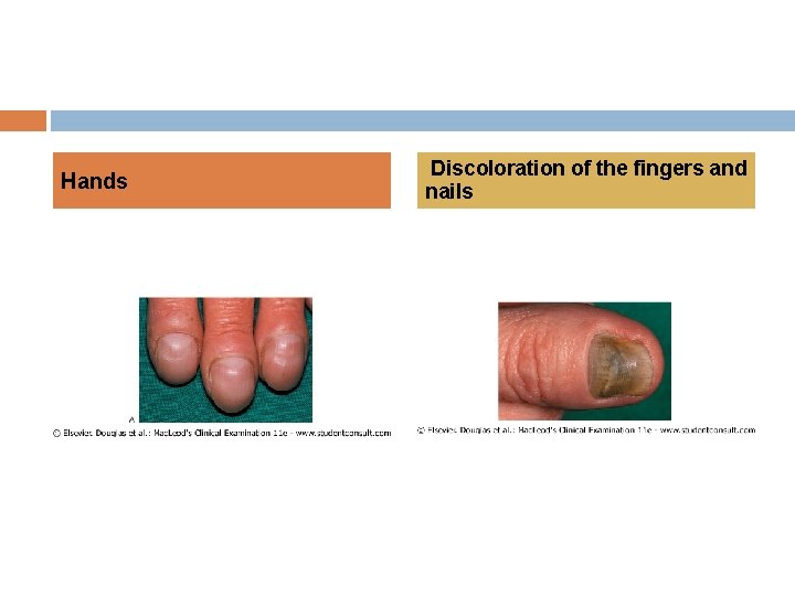 Hands Discoloration of the fingers and nails 