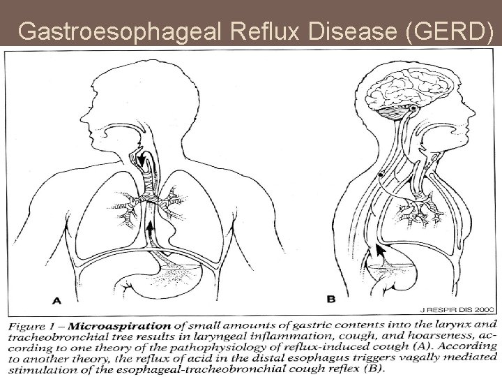 Gastroesophageal Reflux Disease (GERD) 