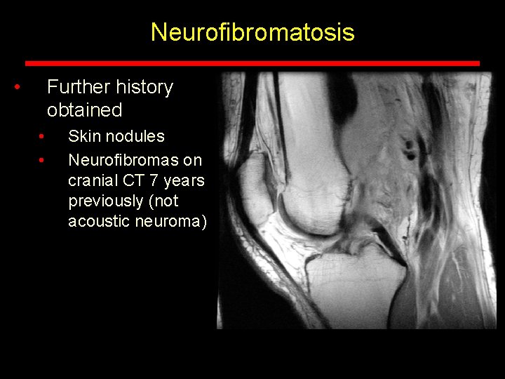 Neurofibromatosis • Further history obtained • • Skin nodules Neurofibromas on cranial CT 7 Neurofibromatosis • Further history obtained • • Skin nodules Neurofibromas on cranial CT 7