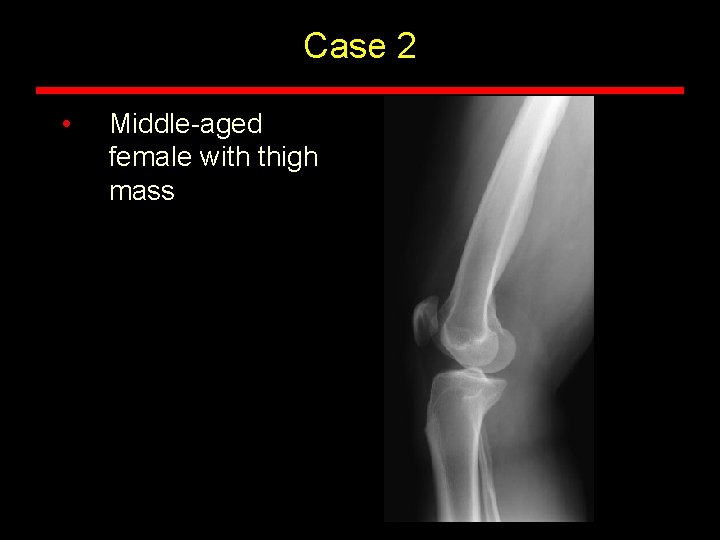 Case 2 • Middle-aged female with thigh mass Case 2 • Middle-aged female with thigh mass