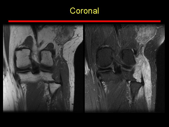 Coronal Coronal