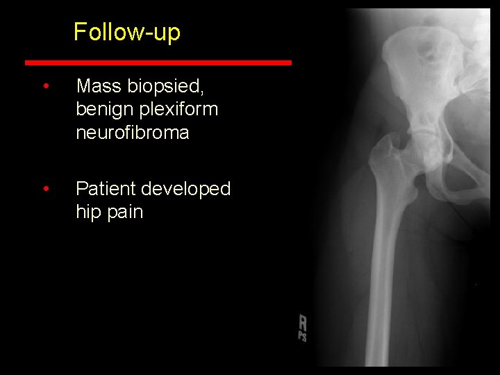 Follow-up • Mass biopsied, benign plexiform neurofibroma • Patient developed hip pain Follow-up • Mass biopsied, benign plexiform neurofibroma • Patient developed hip pain