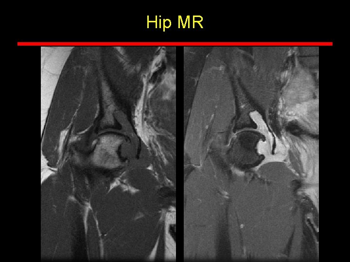 Hip MR Hip MR