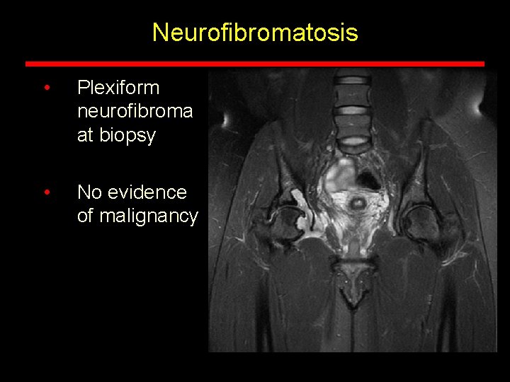 Neurofibromatosis • Plexiform neurofibroma at biopsy • No evidence of malignancy Neurofibromatosis • Plexiform neurofibroma at biopsy • No evidence of malignancy