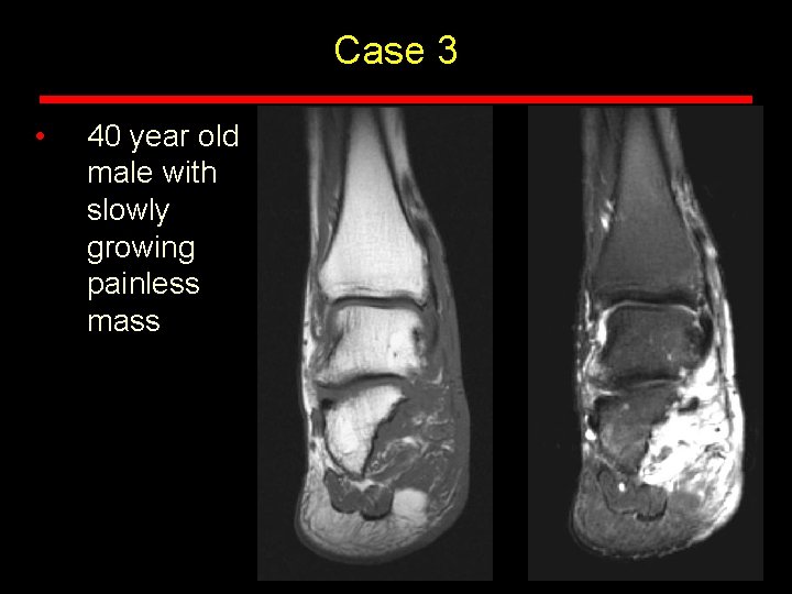 Case 3 • 40 year old male with slowly growing painless mass Case 3 • 40 year old male with slowly growing painless mass