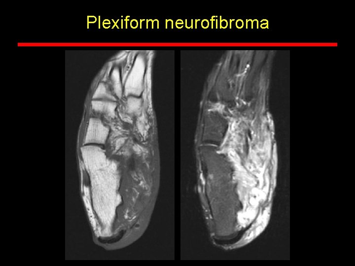 Plexiform neurofibroma Plexiform neurofibroma