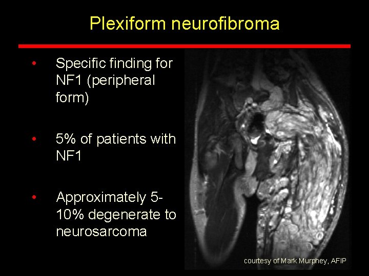 Plexiform neurofibroma • Specific finding for NF 1 (peripheral form) • 5% of patients Plexiform neurofibroma • Specific finding for NF 1 (peripheral form) • 5% of patients