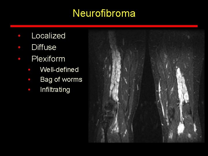 Neurofibroma • • • Localized Diffuse Plexiform • • • Well-defined Bag of worms Neurofibroma • • • Localized Diffuse Plexiform • • • Well-defined Bag of worms