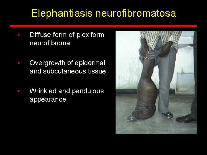 Elephantiasis neurofibromatosa • Diffuse form of plexiform neurofibroma • Overgrowth of epidermal and subcutaneous Elephantiasis neurofibromatosa • Diffuse form of plexiform neurofibroma • Overgrowth of epidermal and subcutaneous