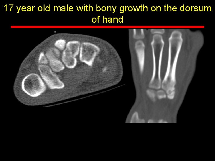17 year old male with bony growth on the dorsum of hand 17 year old male with bony growth on the dorsum of hand