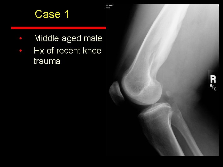 Case 1 • • Middle-aged male Hx of recent knee trauma Case 1 • • Middle-aged male Hx of recent knee trauma