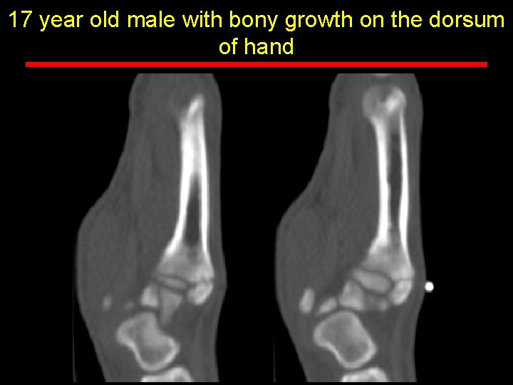 17 year old male with bony growth on the dorsum of hand 17 year old male with bony growth on the dorsum of hand